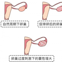这6种情况要「冷冻胚胎」，不能(néng)移植鲜胚！